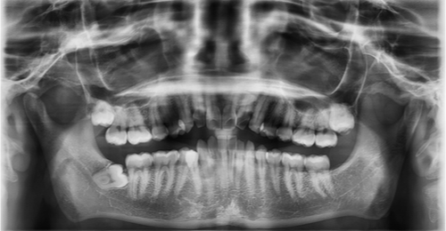 Endodontic Management - Case Report - Dentistry - Research - Taurodontia - Palatal Canals